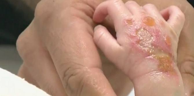 Intravenous fluid administration leaves newborn with blisters
