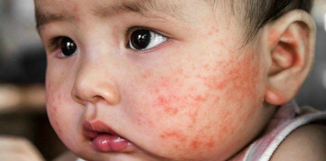 Study Links Baby Wipes to Food Allergies in Children