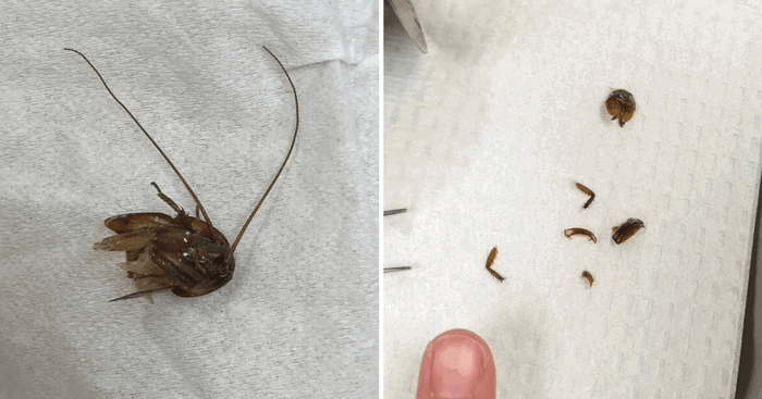 Cockroach Lives In Woman's Ear For Days: How To Get A Bug Out Of A Kid's Ear?