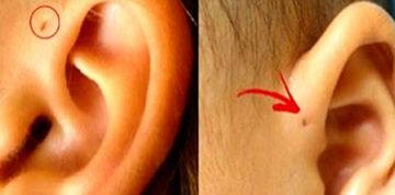 Preauricular Ear Pit Baby: Should Parents Be Worried About This Hole?