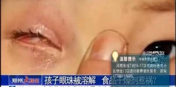 Desiccant pack explodes, leaving boy blind in one eye