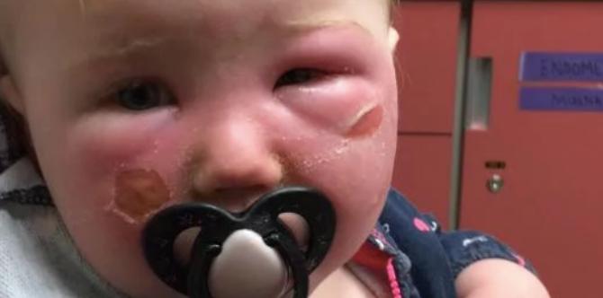 14-Month Old Baby Suffers Serious Burns From Aerosol Sunscreen