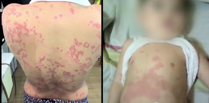 Baby's skin allergies caused by mum's fake whitening products
