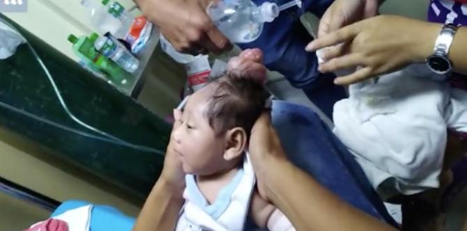 Baby born with horn on his head: What caused this?