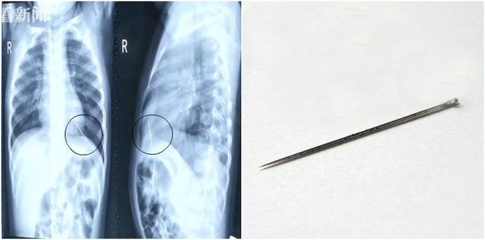 Needle Found in Toddler's Heart During a Check for Chronic Cough