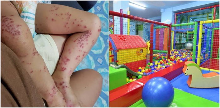 Toddler Catches HFMD, Possibly From An Indoor Playground