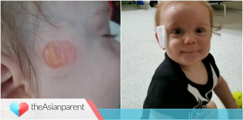 Pacifier Damage Pacifier Burns: Mum Shares How Her Baby Suffered Suction Burns
