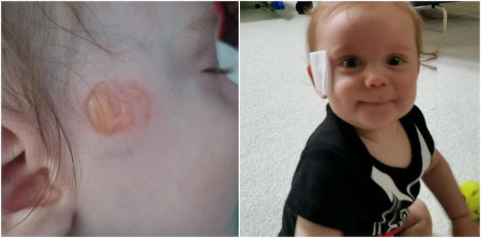 Infant suffers blister like burns on face after falling asleep with pacifier