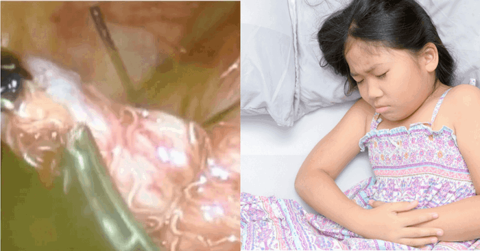 How Do You Know if Your Child Has Worms: Signs, Symptoms and Treatment