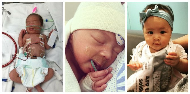 'Breast Milk Helped My Premature Baby Overcome Meningitis and Surgery'