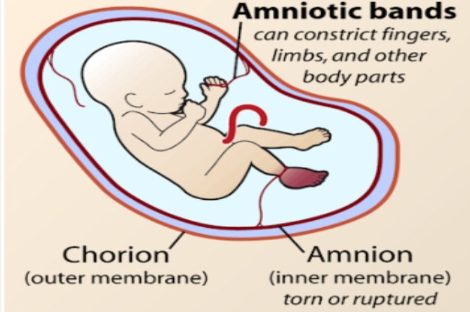 Amniotic Band Syndrome Face Amniotic Band Syndrome Face