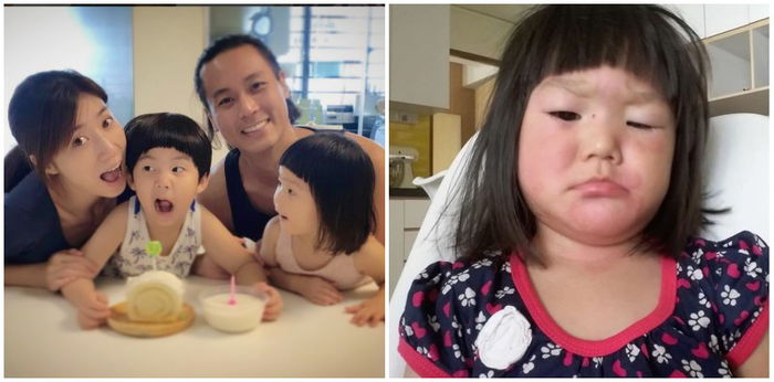 Andie Chen and Kate Pang's daughter has swollen face after allergic reaction