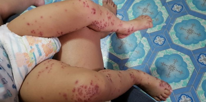 UPDATED 13 Feb 2019: Childcare centres in Singapore affected by HFMD