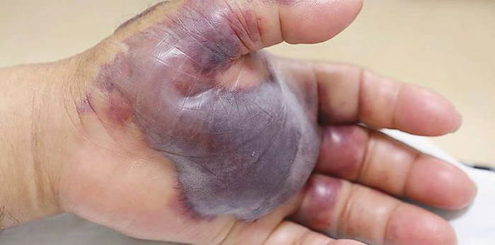 Can Eating Raw Fish Make You Sick? This Man Lost His Arm...