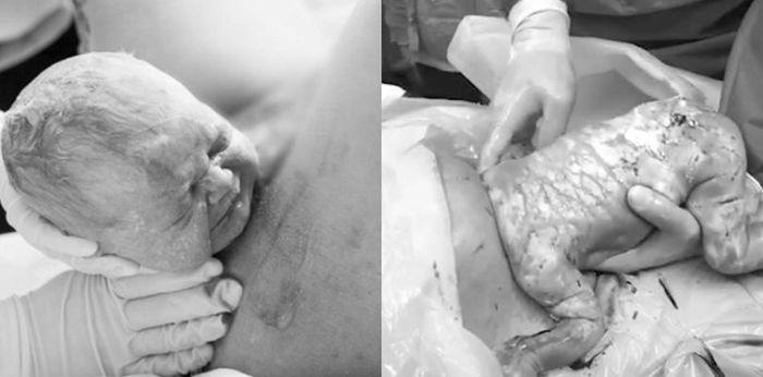 VBAC or C section: Which Should I Choose For My Second Pregnancy?