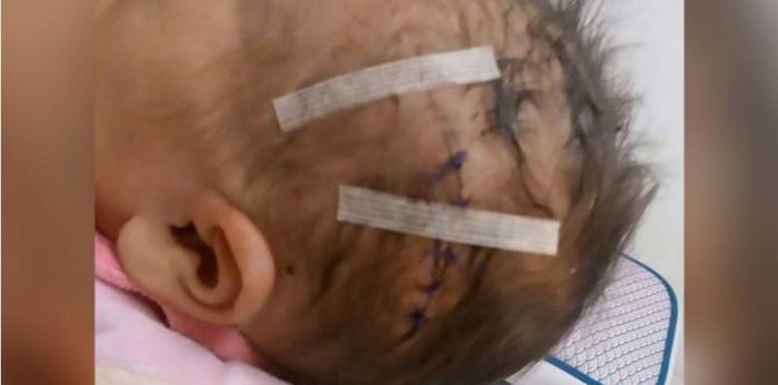 Newborn's Head Sliced by Scalpel During C-section: C-section Injuries