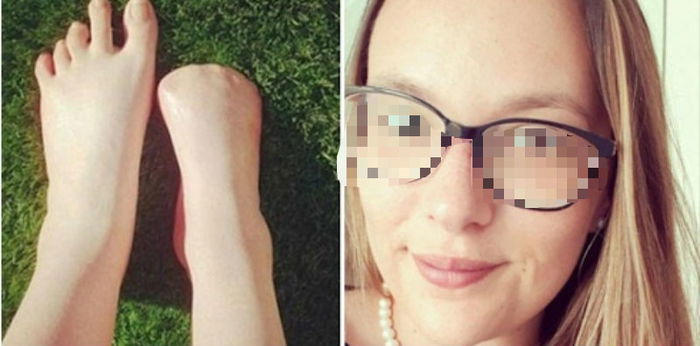 Trying out fish spas leads to ALL of this woman's toes being amputated