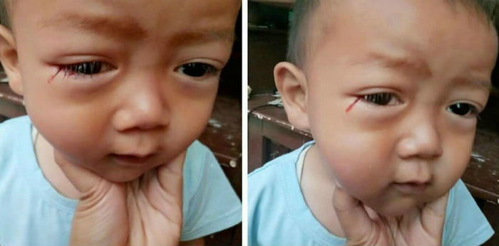 Haemolacria, Or Bloody Tears: What Causes It In Children?