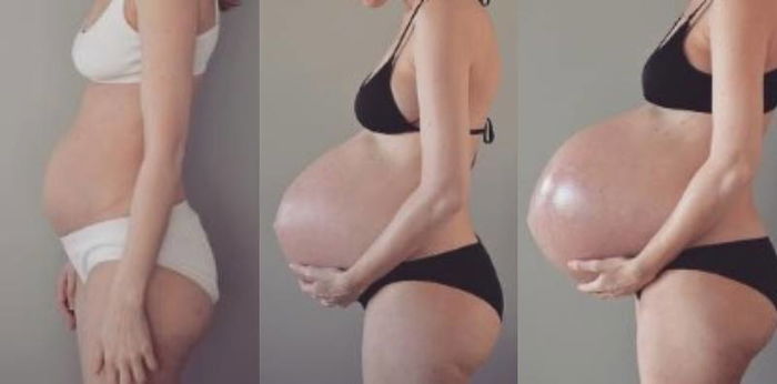 Mum Pregnant With Triplets Shows Off Massive Baby Bump