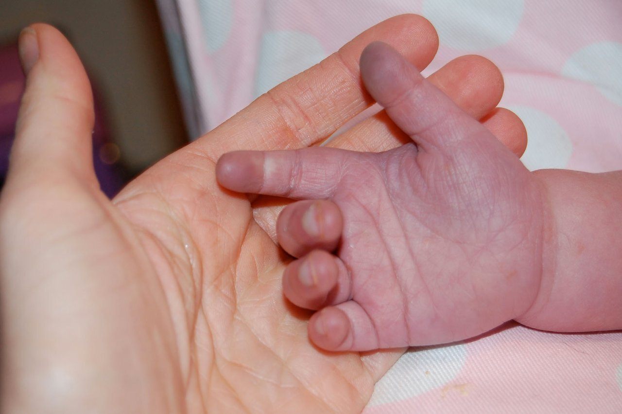 Blue Baby Disease What Parents Need To Know About It