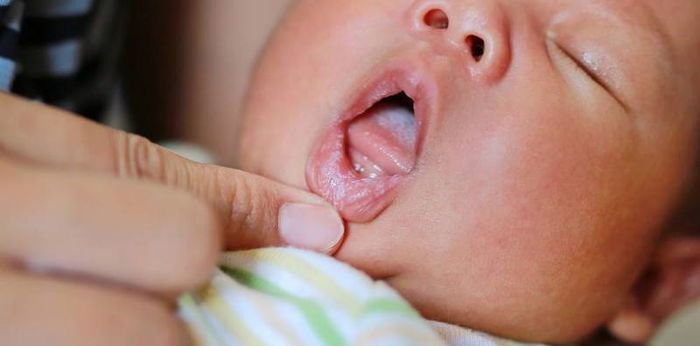 Newborn Thrush vs Milk Tongue: How to Tell the Difference and What Is the Right Treatment
