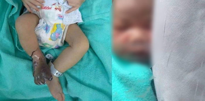 Baby's foot bloated and discoloured due to possible hospital negligence