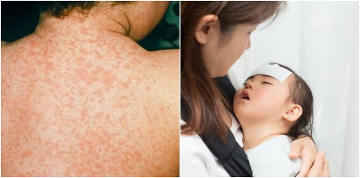 Travellers urged to get vaccinated after measles outbreak in Thailand