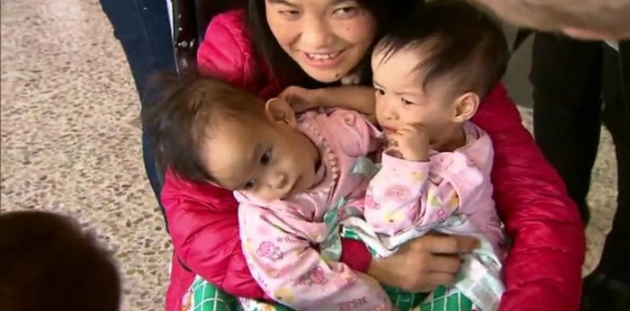successful separation of conjoined twins
