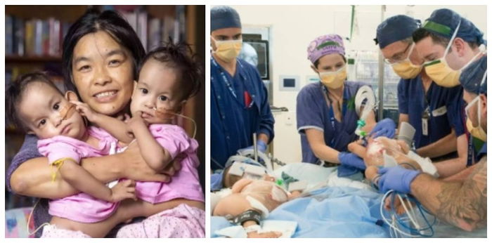 Conjoined Bhutanese twins successfully detached in Australian surgery