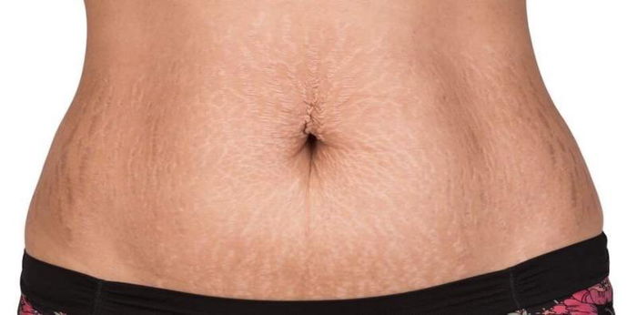 This is how you can tighten saggy belly skin after giving birth