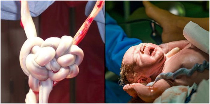 What Parents Should Know About Cord Around the Neck Symptoms