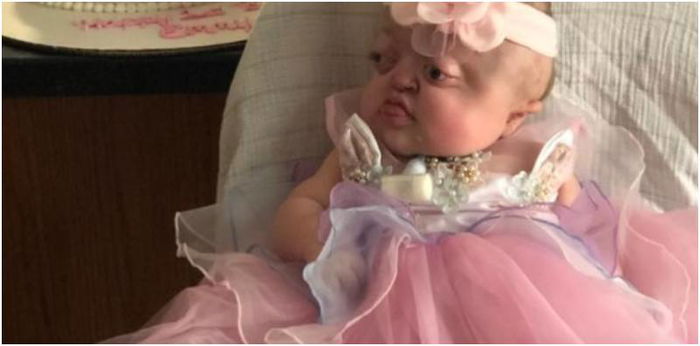 Pfeiffer Syndrome: A Rare Genetic Syndrome To Learn About