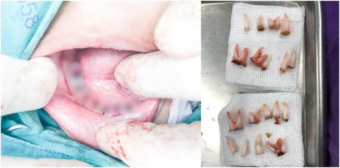 4 Year-old-boy Loses 18 Teeth Because of This Common Bad Habit Parents Practice