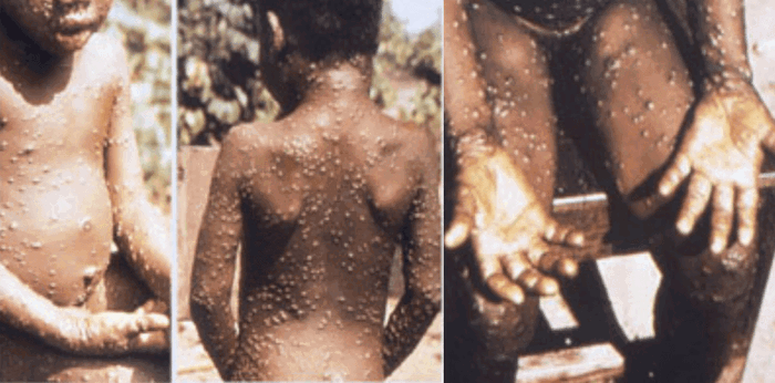 What is monkeypox: Everything you need to know about this rare disease