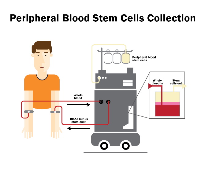 bone marrow donation in Singapore
