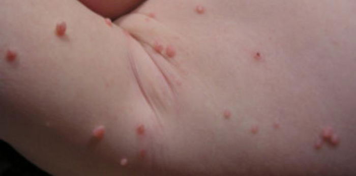 Molluscum Contagiosum: Remedies And How To Prevent It From Spreading