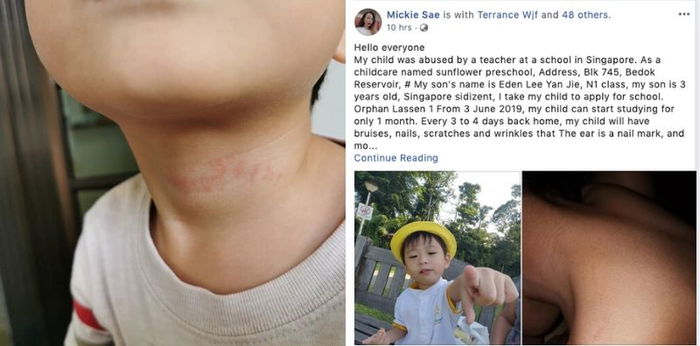Mother Claims That Her 3-Year-Old Son Was Abused By Preschool Teachers In Bedok