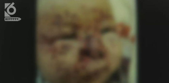 Mice Chews Off Part Of Baby’s Nose After Being Left With Milk Residue On Face