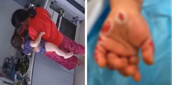 Maid Sentenced To 14 Months' Jail After Dipping Toddler's Hand Into A Pot Of Boiling Water