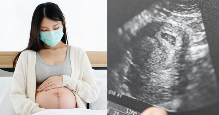 COVID-19: Unborn Child Unlikely to Be Affected If Mum Contracts Coronavirus, Says Expert