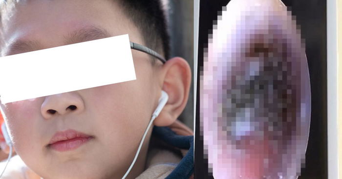 Boy Grows 'Moulds' in Ear Canal, Said To Be Due To Wearing Earphones Too Often