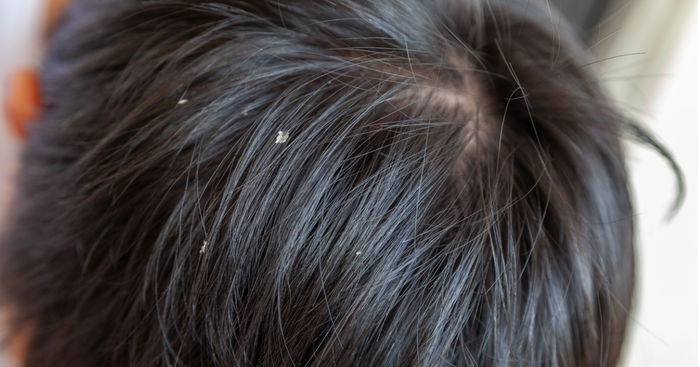 Toddler Dandruff: Symptoms and Remedies
