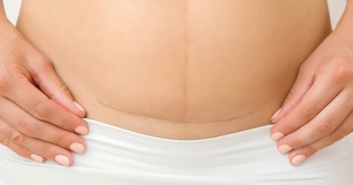'Apparently I Didn't Give Birth Because I Had a Caesarean'