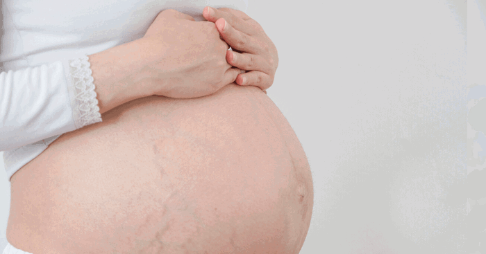 Best Stretch Mark Prevention During Pregnancy