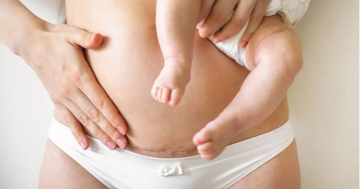 C-Section Complications