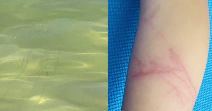 Child Stung by Deadly Box Jellyfish in Sentosa, Advisory Issued to Public to Take Caution