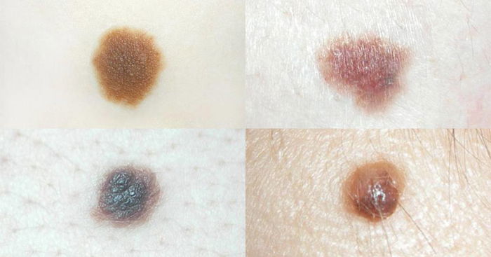 When To Worry About Moles on Your Child: Different Types and Skin Cancer Risks