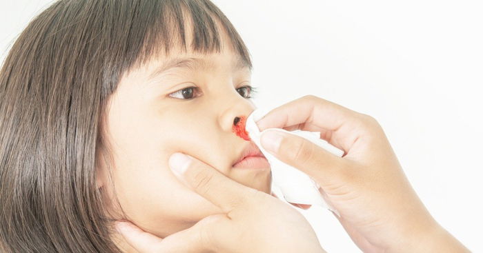 Everything You Need to Know About Nosebleeds in Children