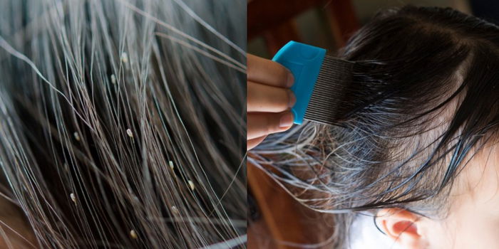 ‘My Family Struggled With Head Lice for 8 Years and Never Again’