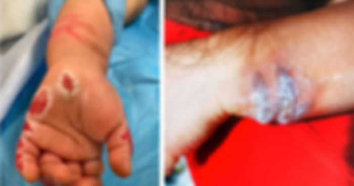 Mother Unhappy With Verdict After Maid Who Forced Toddler's Hand Into Boiling Water Gets 14 Months Of Jail Time